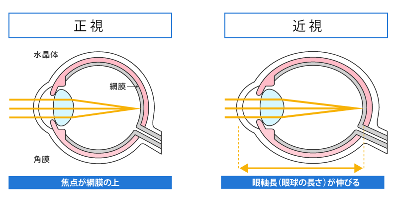 なぜ近視の進行を抑制することが大切なのか