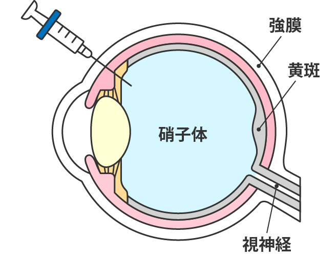 硝子体内注射とは