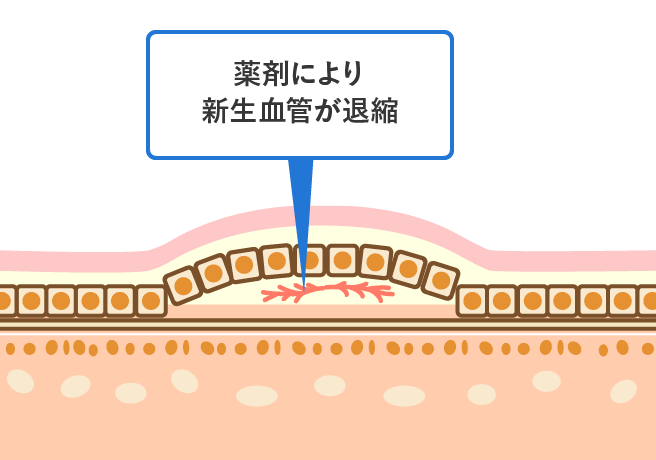 抗VEGF薬の働き