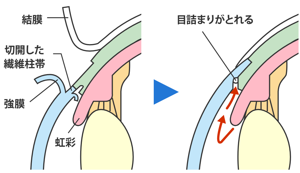 線維柱帯切開術（眼内法）