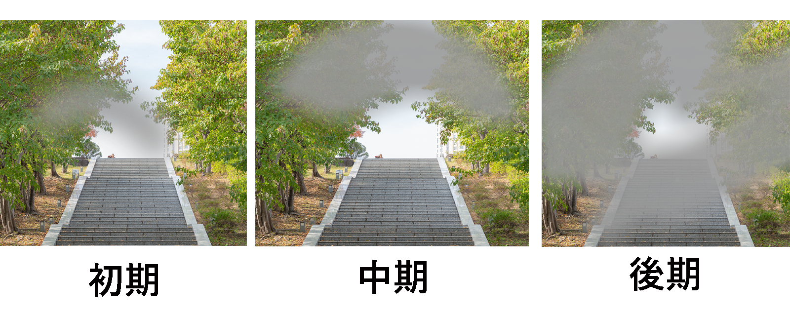 緑内障進行