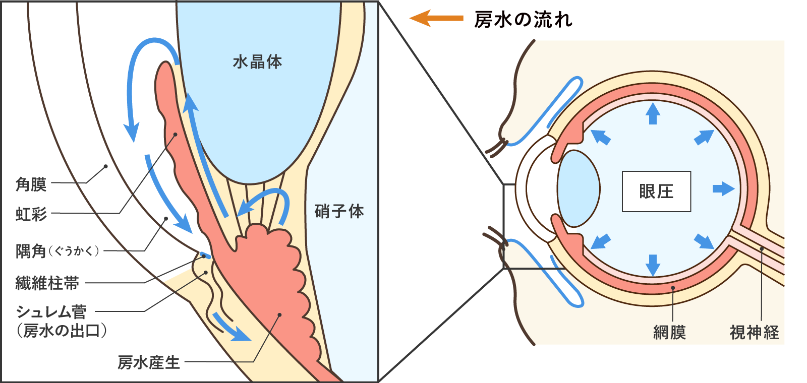 緑内障の主な種類